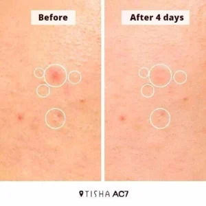 tisha-ac7-acne-spot-serum-15ml-pic-5